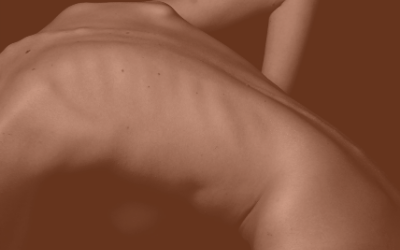 WARNING!!! Check your Moles (Graphic images) #Safetyinbeauty