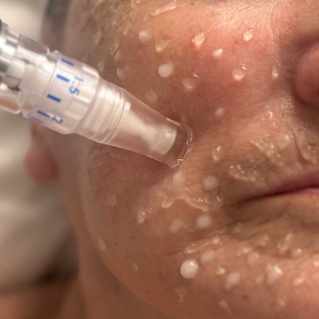 SkinPen® with Polynucleotides and NAD+