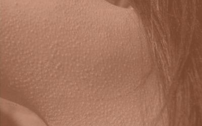 What is Keratosis Pilaris