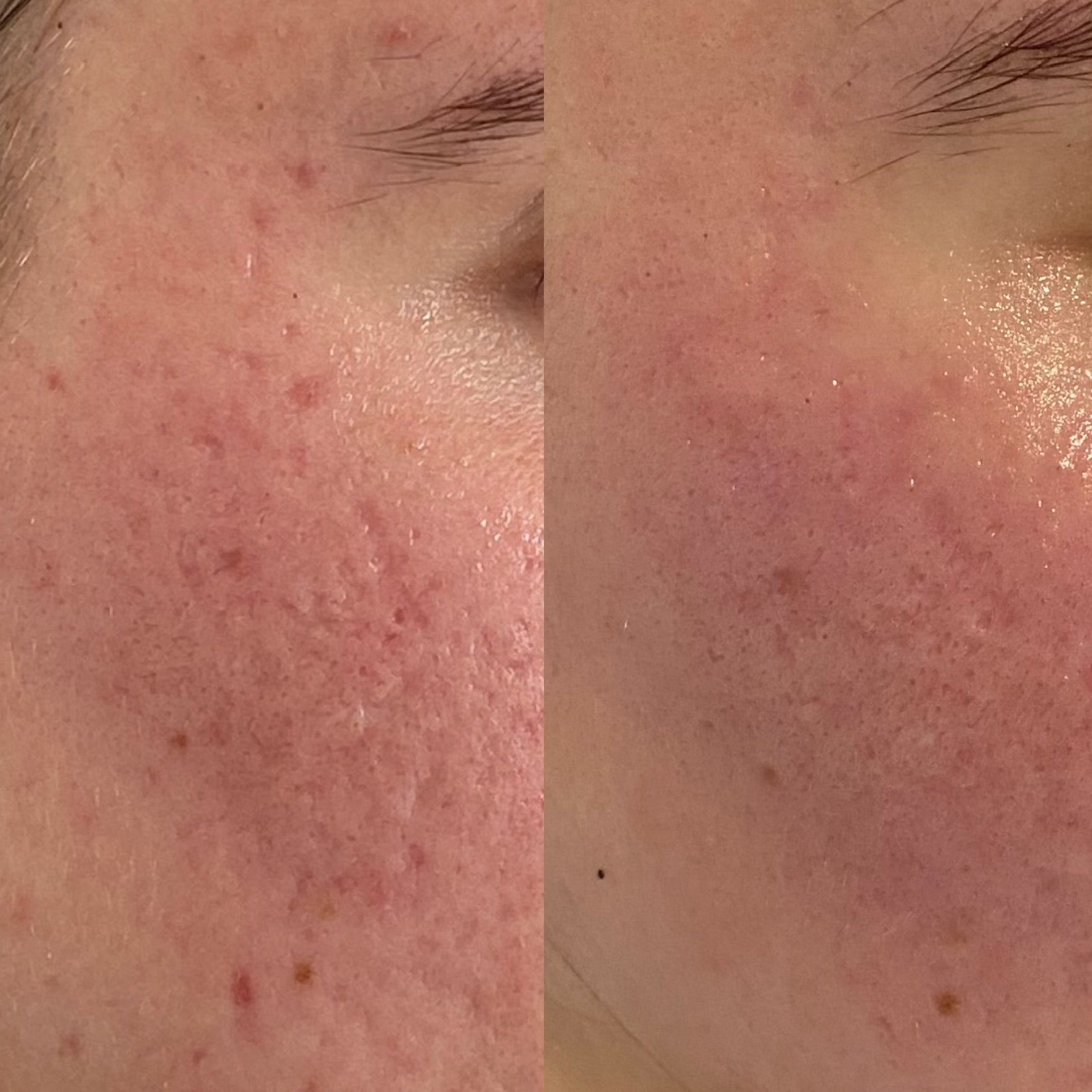 Acne Scar - Acu Lift