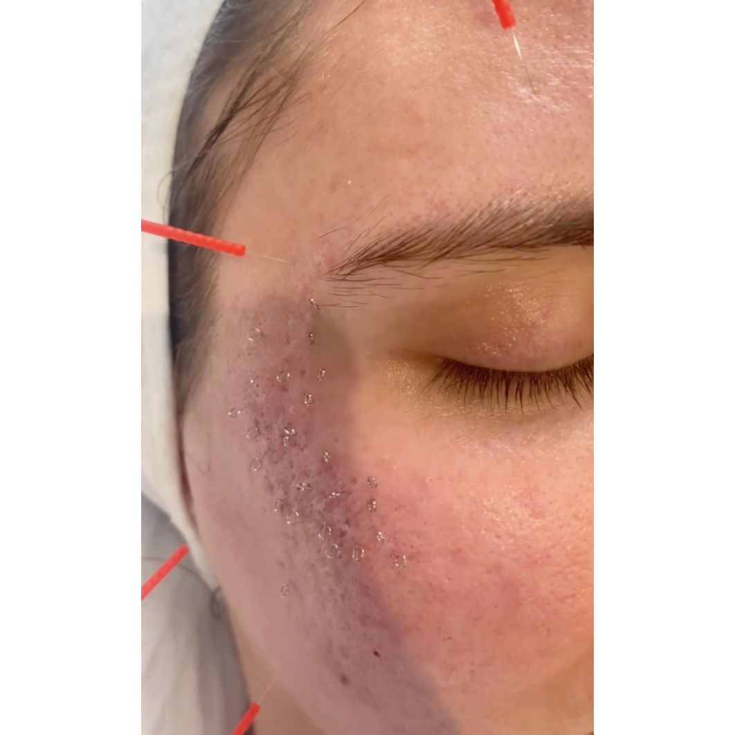 Acne Scar - Acu Lift