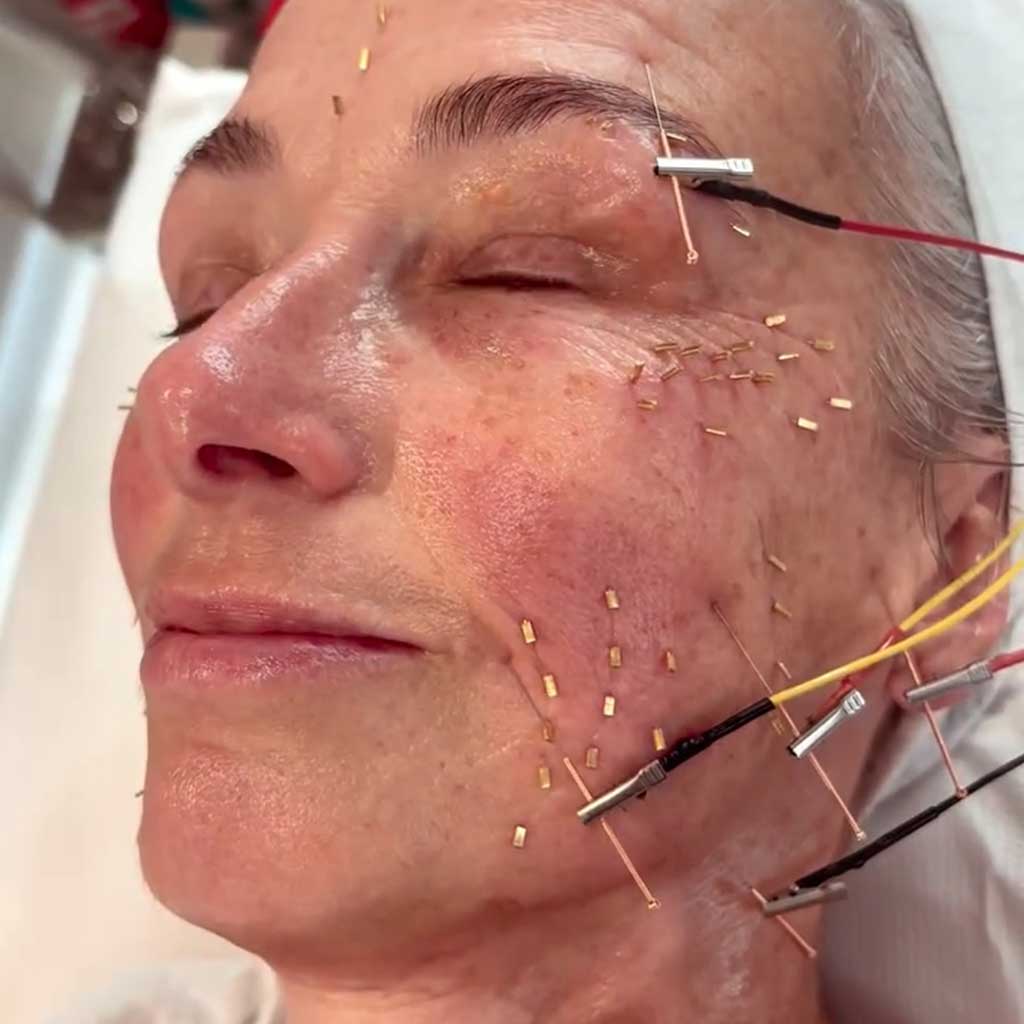 Cosmetic Acupuncture
