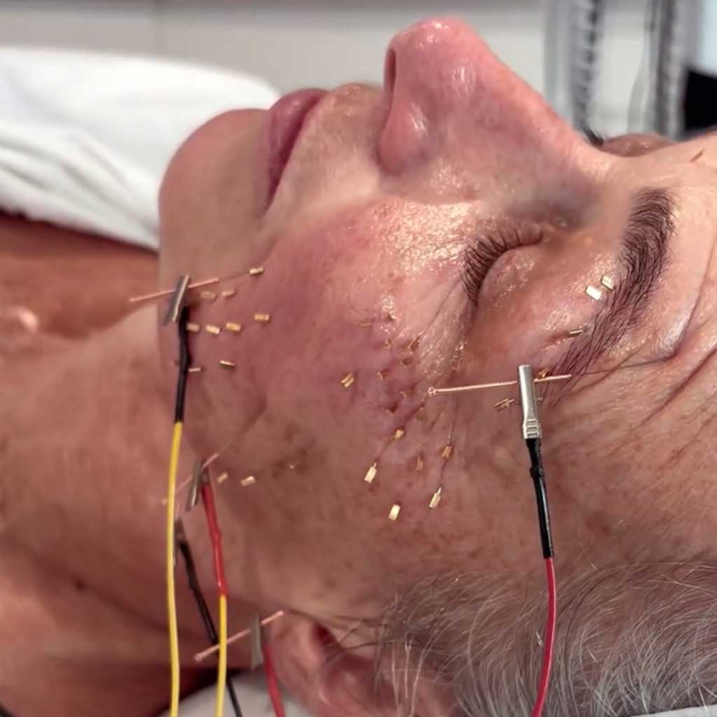 Cosmetic Acupuncture