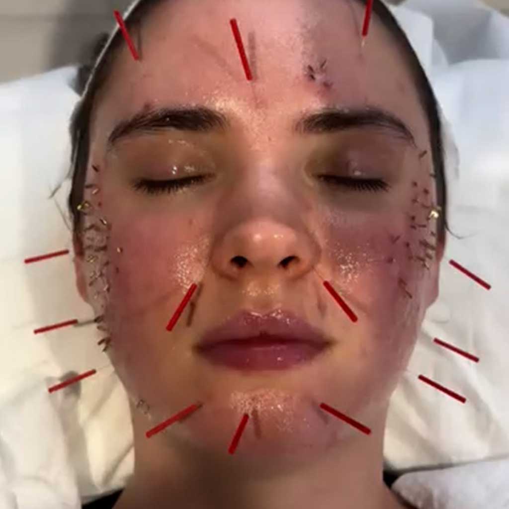Cosmetic Acupuncture