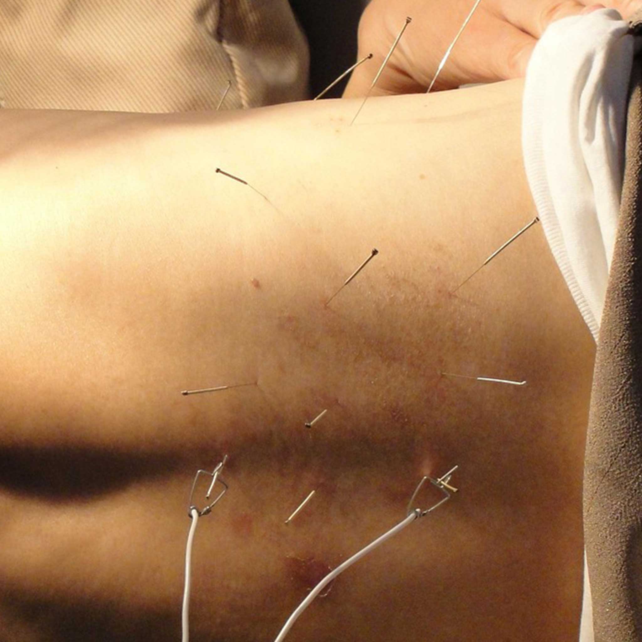 Acupuncture