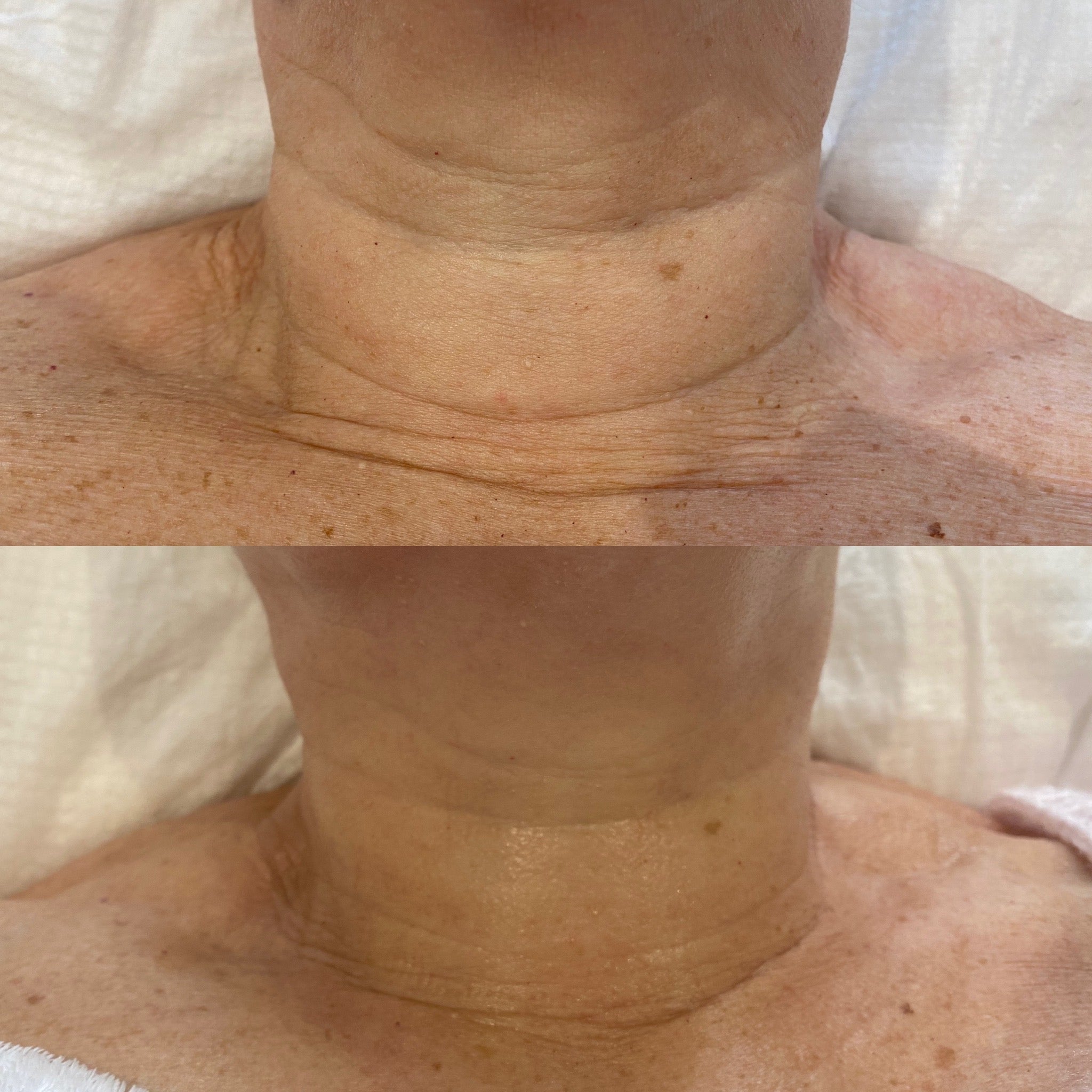 Qi Beauty -  Neck Lift